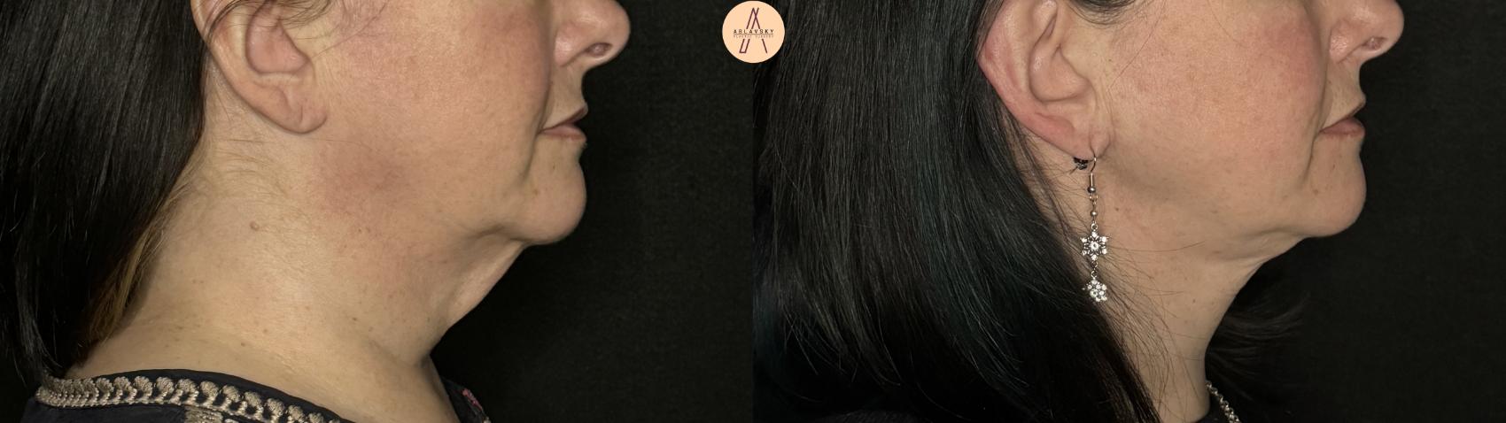 Before & After Facelift & Neck Lift Case 294 Right Side View in San Antonio, Texas