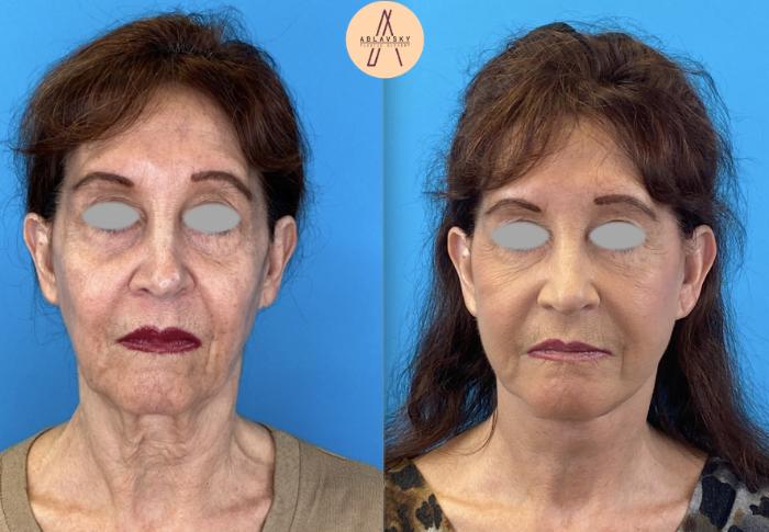 Before & After Facelift & Neck Lift Case 3 Front View in San Antonio, Texas