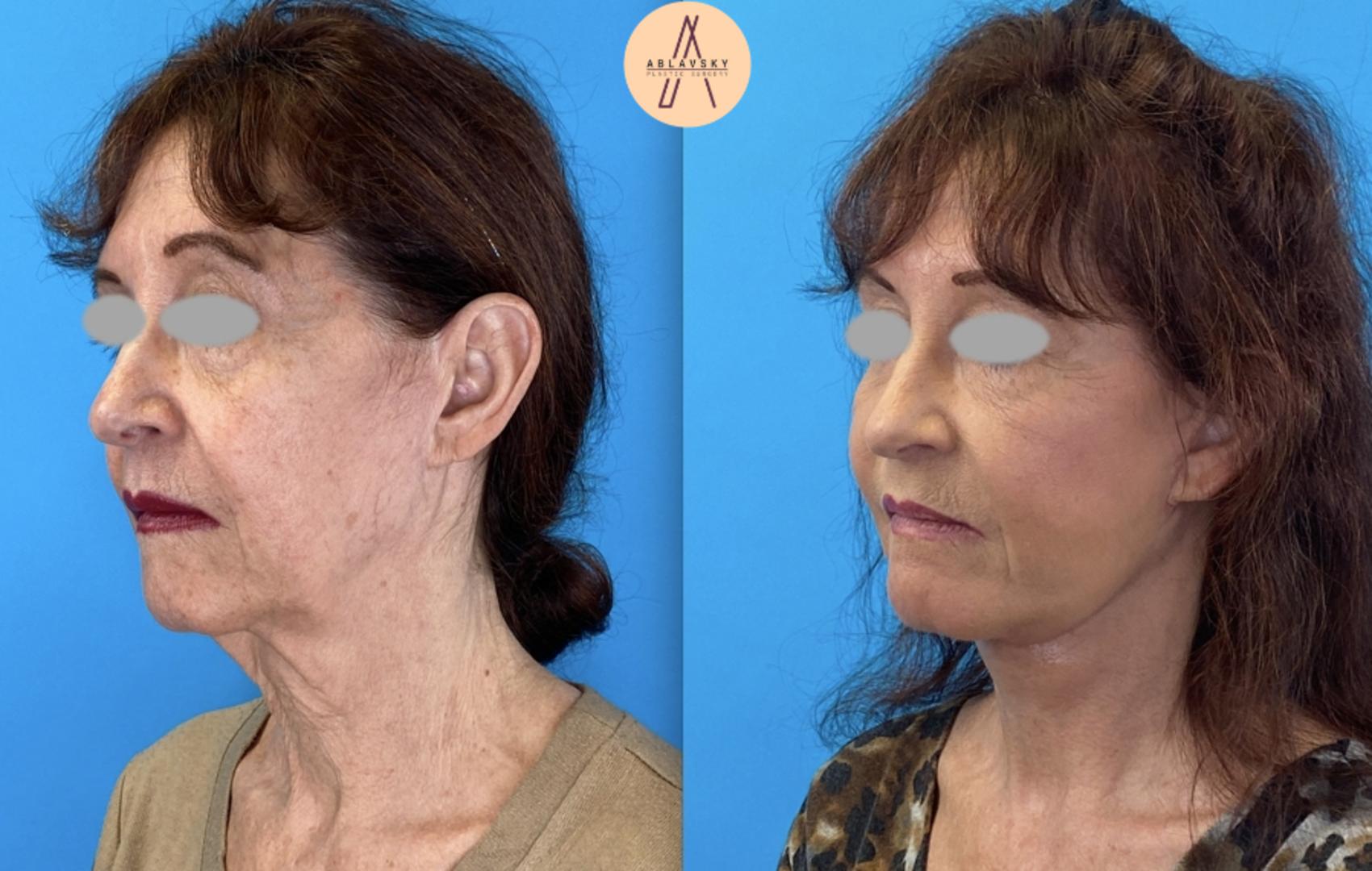 Before & After Facelift & Neck Lift Case 3 Left Oblique View in San Antonio, Texas