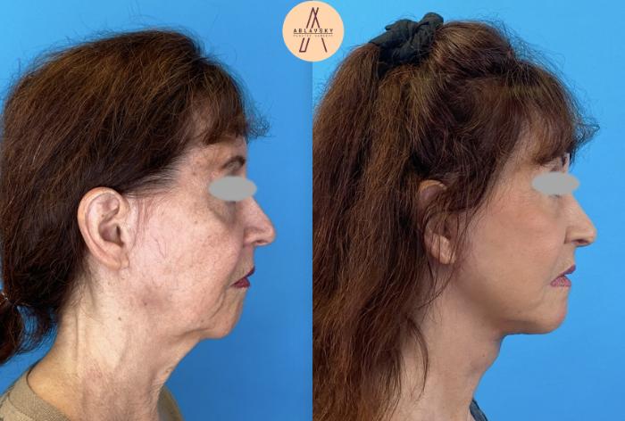 Before & After Facelift & Neck Lift Case 3 Right Side View in San Antonio, Texas