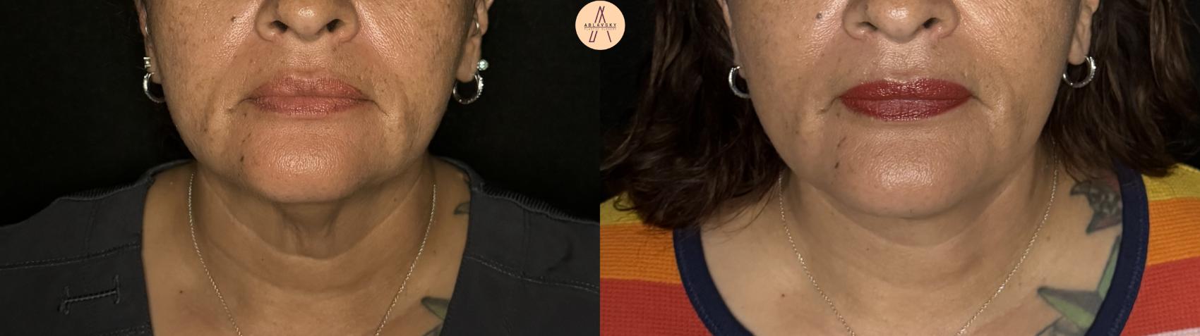 Before & After Facelift & Neck Lift Case 306 Front View in San Antonio, Texas