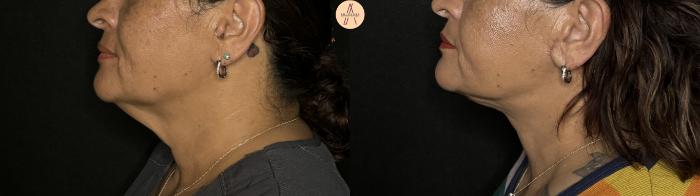 Before & After Facelift & Neck Lift Case 306 Left Side View in San Antonio, Texas