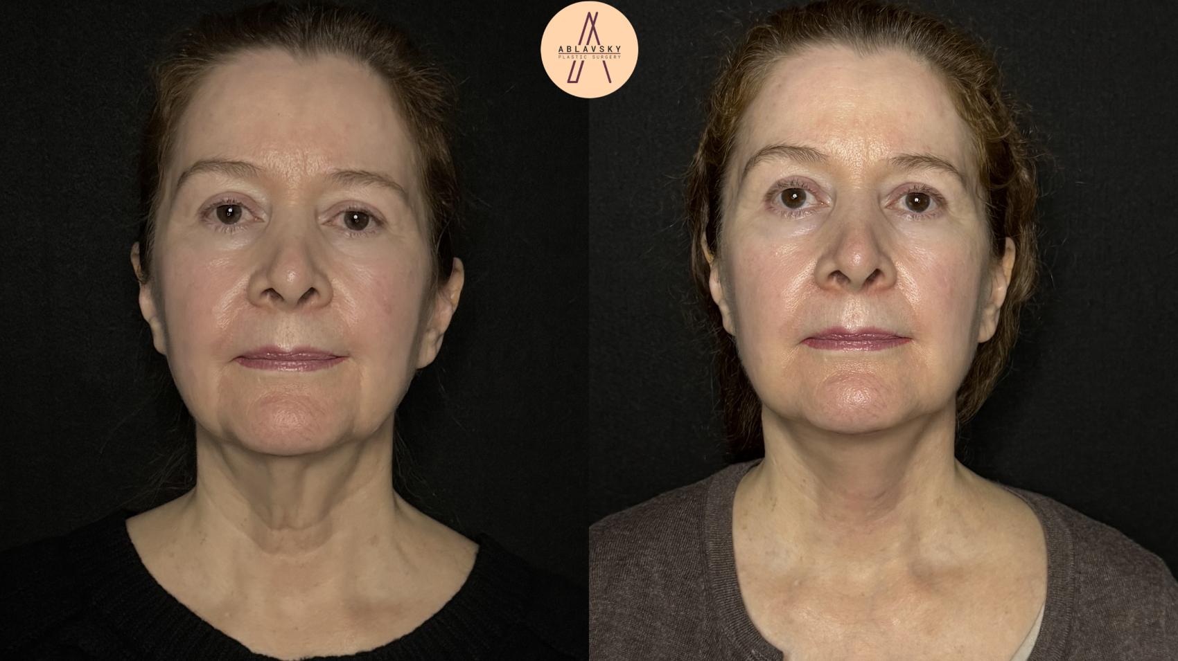 Before & After Facelift & Neck Lift Case 347 Front View in San Antonio, Texas