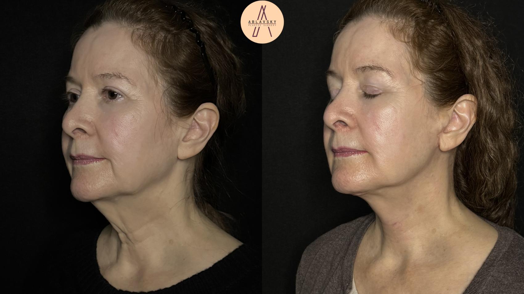 Before & After Facelift & Neck Lift Case 347 Left Oblique View in San Antonio, Texas