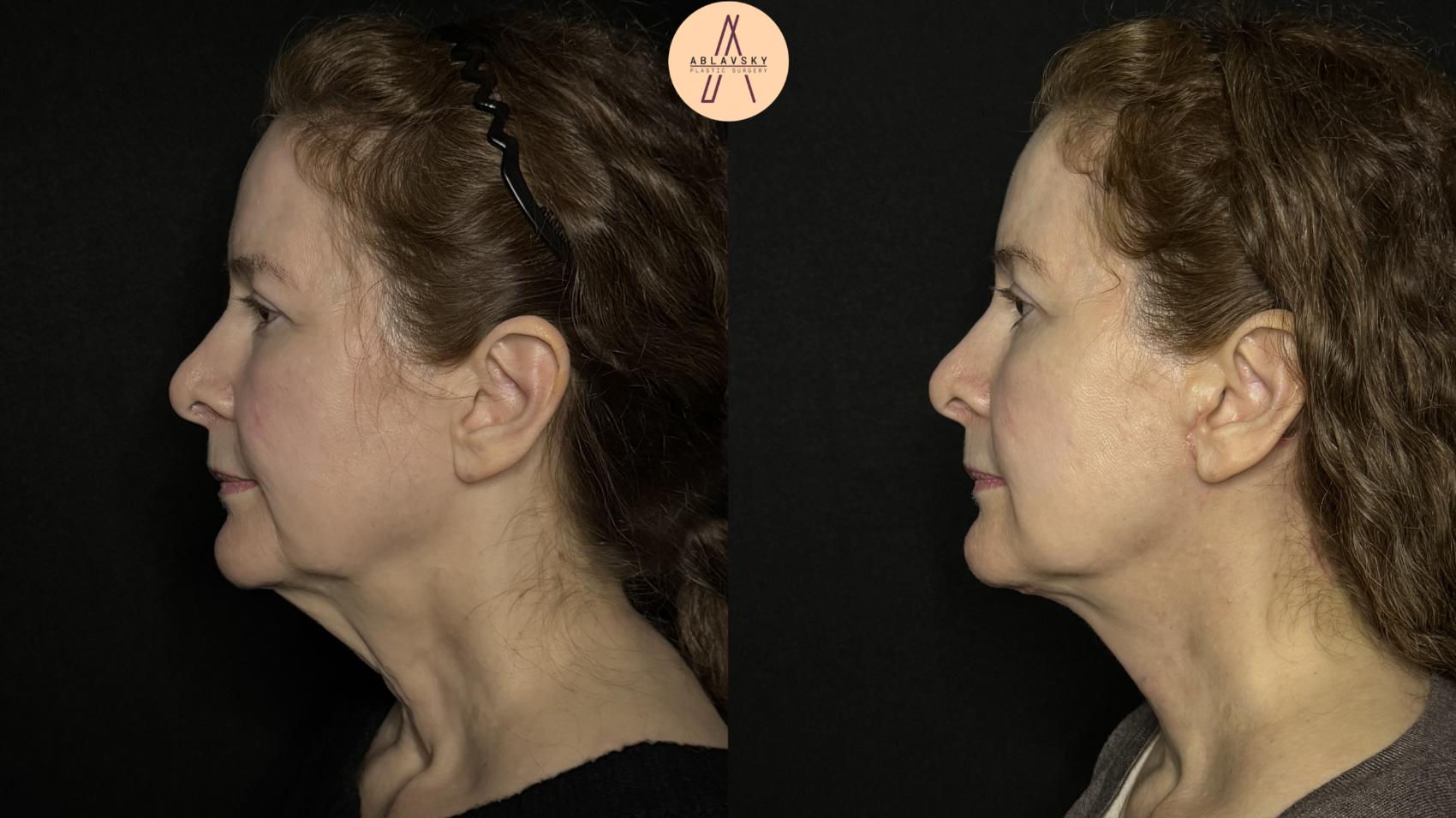 Before & After Facelift & Neck Lift Case 347 Left Side View in San Antonio, Texas