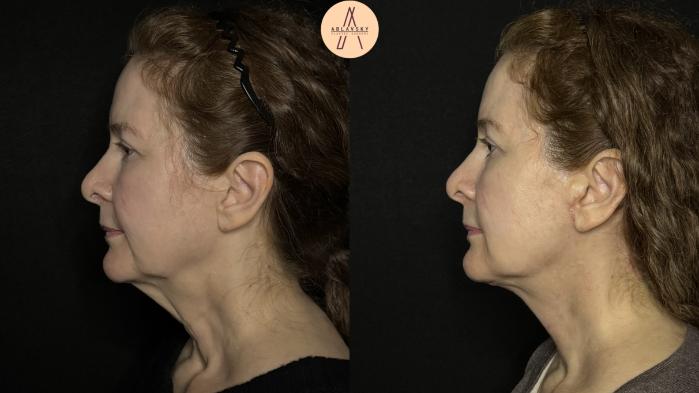 Before & After Facelift & Neck Lift Case 347 Left Side View in San Antonio, Texas