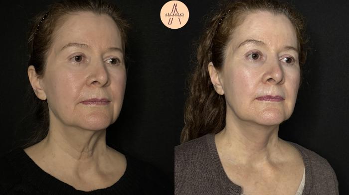 Before & After Facial Fat Grafting Case 347 Right Oblique View in San Antonio, Texas