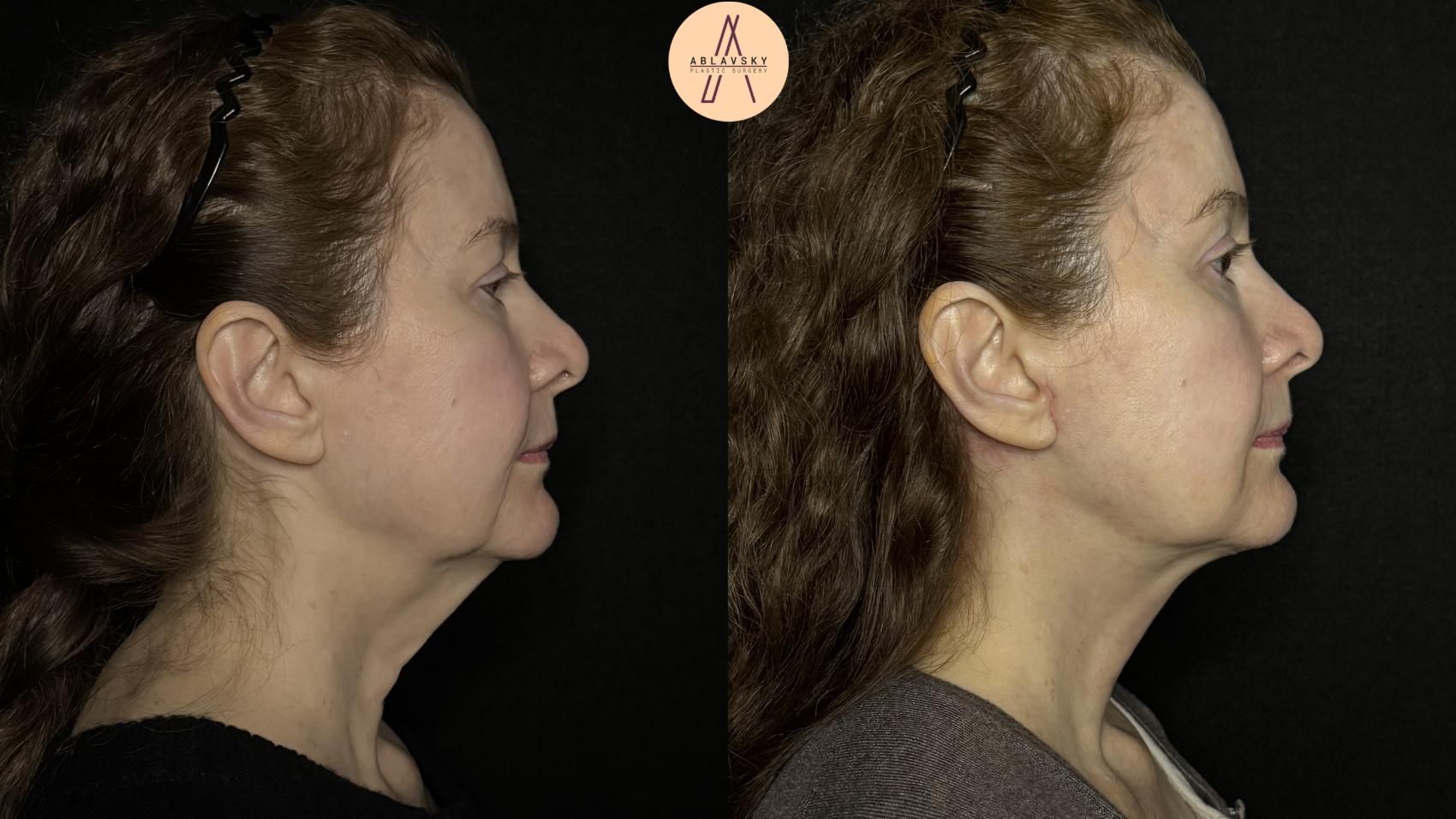 Before & After Facelift & Neck Lift Case 347 Right Side View in San Antonio, Texas