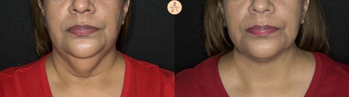 Before & After Facelift & Neck Lift Case 363 Front View in San Antonio, Texas