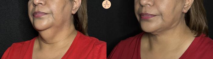Before & After Facelift & Neck Lift Case 363 Left Oblique View in San Antonio, Texas