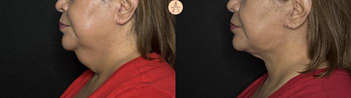 Before & After Facelift & Neck Lift Case 363 Left Side View in San Antonio, Texas