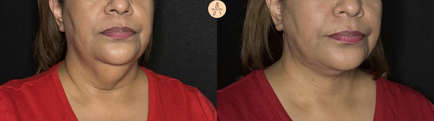 Before & After Facelift & Neck Lift Case 363 Right Oblique View in San Antonio, Texas