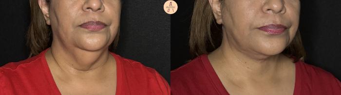 Before & After Facelift & Neck Lift Case 363 Right Oblique View in San Antonio, Texas