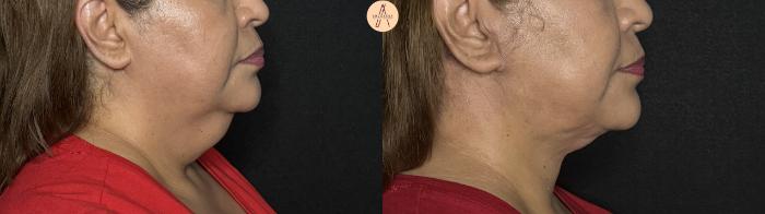 Before & After Facelift & Neck Lift Case 363 Right Side View in San Antonio, Texas