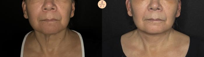 Before & After Facelift & Neck Lift Case 370 Front View in San Antonio, Texas