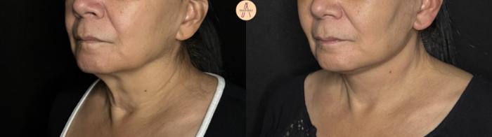 Before & After Facelift & Neck Lift Case 370 Left Oblique View in San Antonio, Texas