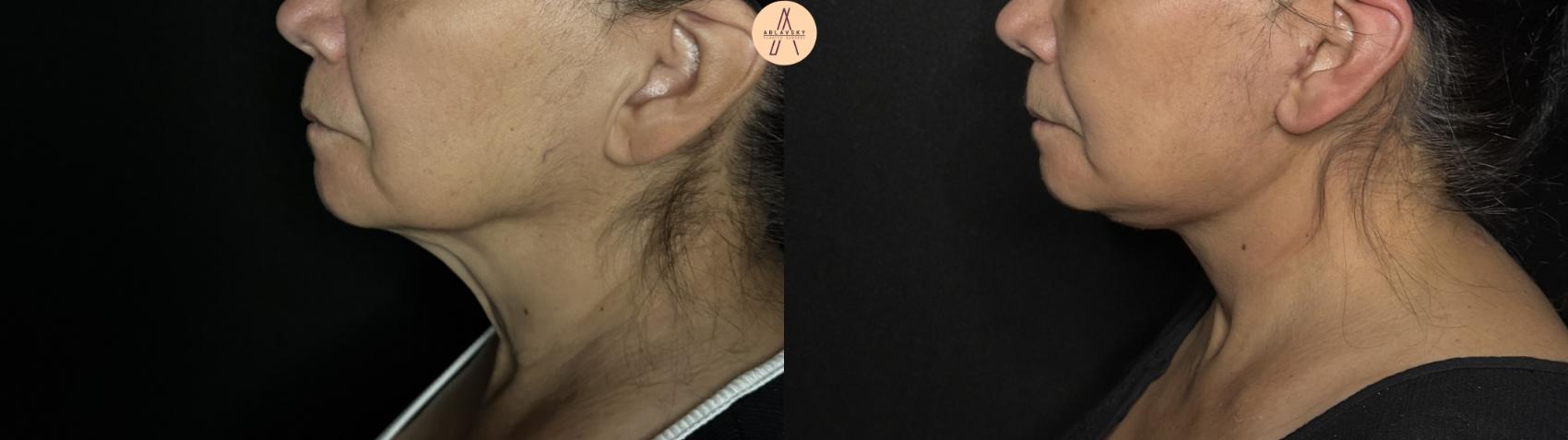 Before & After Facelift & Neck Lift Case 370 Left Side View in San Antonio, Texas