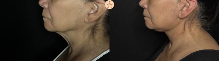 Before & After Facelift & Neck Lift Case 370 Left Side View in San Antonio, Texas