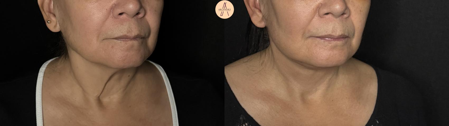 Before & After Facelift & Neck Lift Case 370 Right Oblique View in San Antonio, Texas