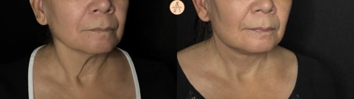 Before & After Facelift & Neck Lift Case 370 Right Oblique View in San Antonio, Texas