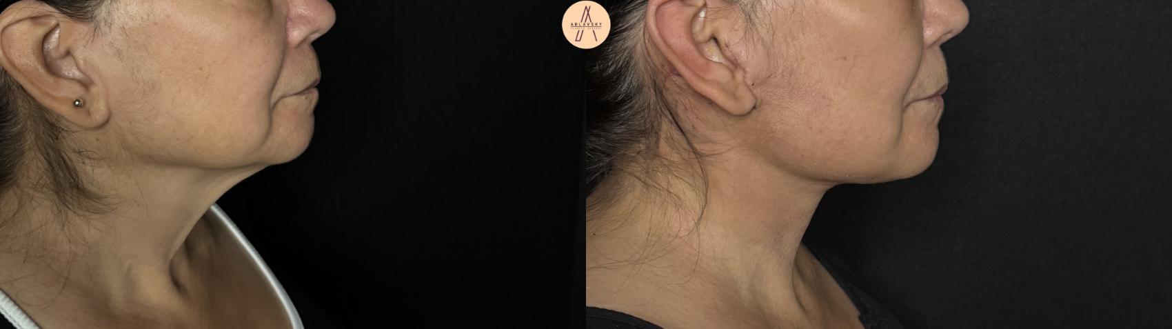 Before & After Facelift & Neck Lift Case 370 Right Side View in San Antonio, Texas