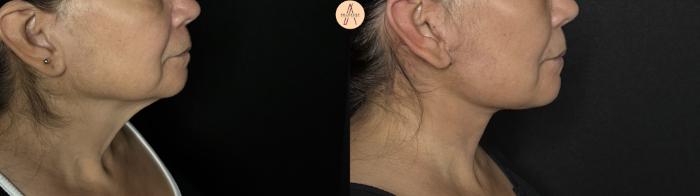 Before & After Facelift & Neck Lift Case 370 Right Side View in San Antonio, Texas