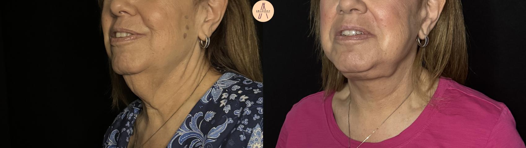 Before & After Facelift & Neck Lift Case 387 Left Oblique View in San Antonio, Texas