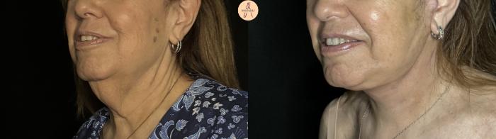 Before & After Facelift & Neck Lift Case 387 Left Oblique View in San Antonio, Texas