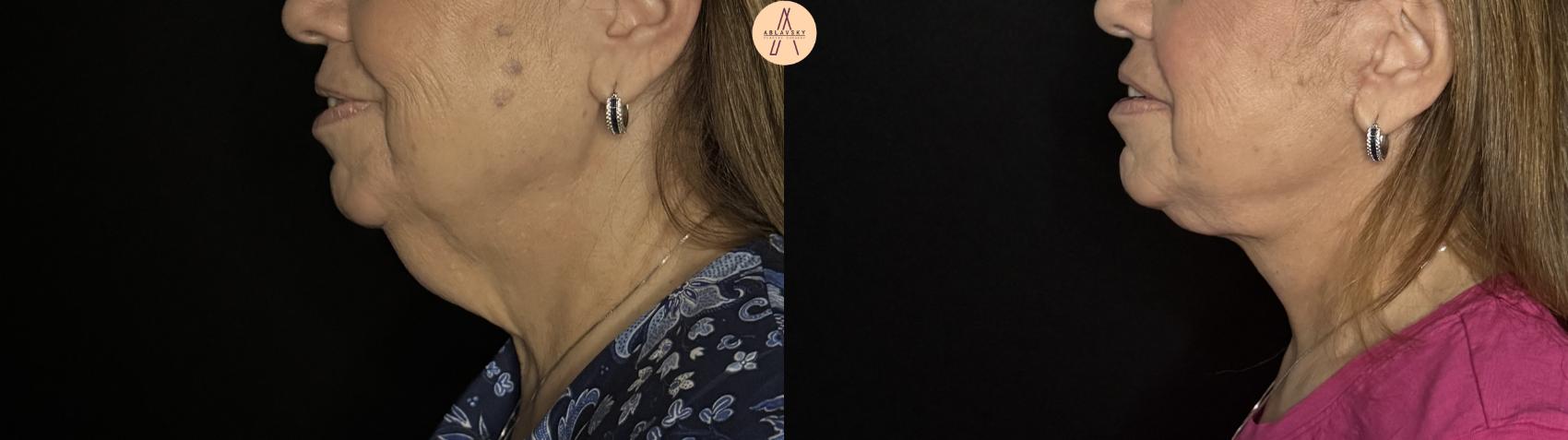 Before & After Facelift & Neck Lift Case 387 Left Side View in San Antonio, Texas