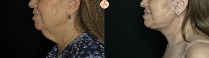 Before & After Facelift & Neck Lift Case 387 Left Side View in San Antonio, Texas