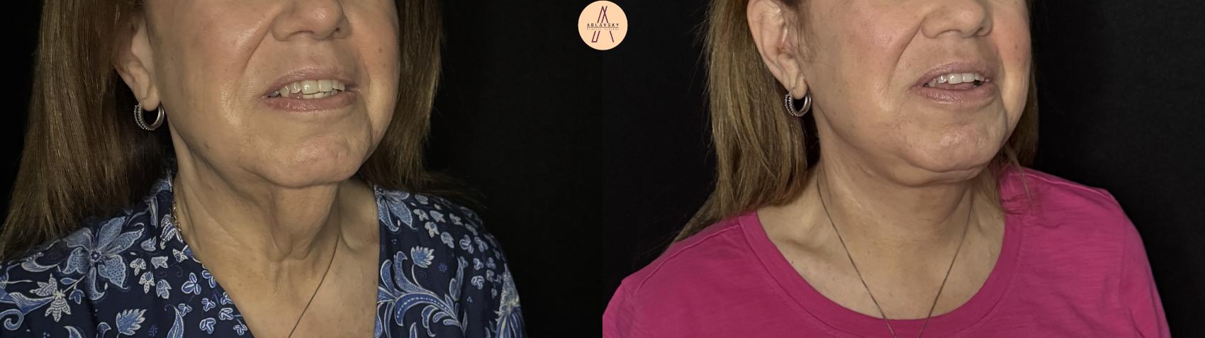 Before & After Facelift & Neck Lift Case 387 Right Oblique View in San Antonio, Texas