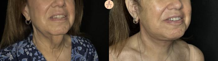 Before & After Facelift & Neck Lift Case 387 Right Oblique View in San Antonio, Texas