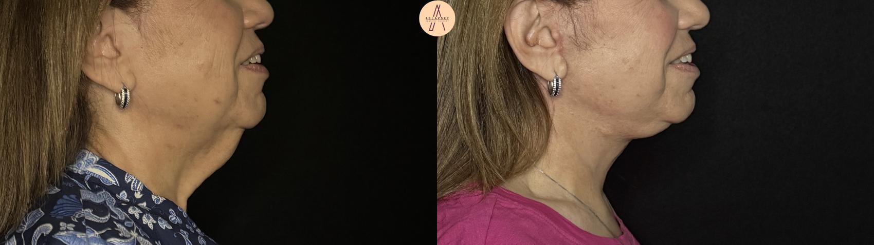 Before & After Facelift & Neck Lift Case 387 Right Side View in San Antonio, Texas