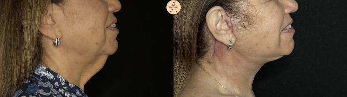 Before & After Facelift & Neck Lift Case 387 Right Side View in San Antonio, Texas