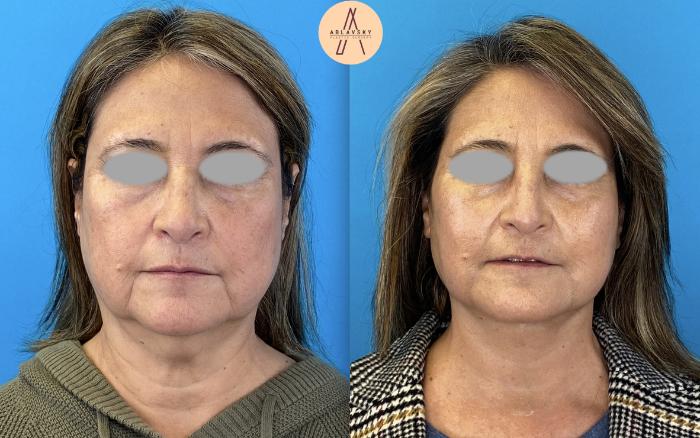 Before & After Facelift & Neck Lift Case 4 Front View in San Antonio, Texas