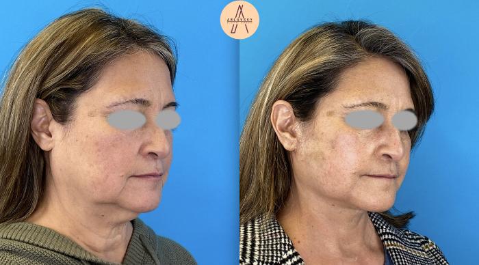 Before & After Facelift & Neck Lift Case 4 Right Oblique View in San Antonio, Texas