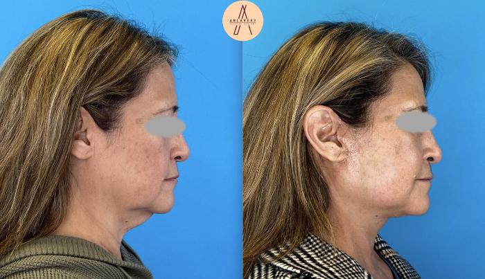 Before & After Facelift & Neck Lift Case 4 Right Side View in San Antonio, Texas