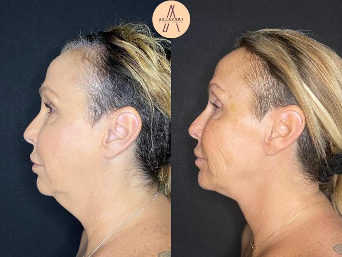 Before & After Facelift & Neck Lift Case 45 Left Side View in San Antonio, Texas