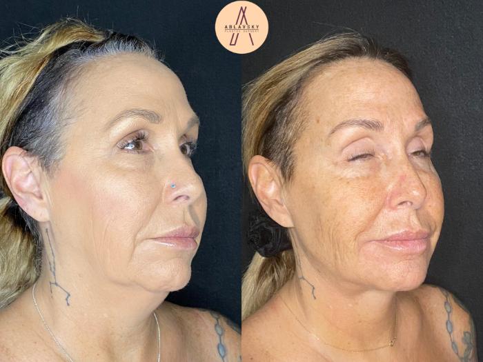 Before & After Facelift & Neck Lift Case 45 Right Oblique View in San Antonio, Texas