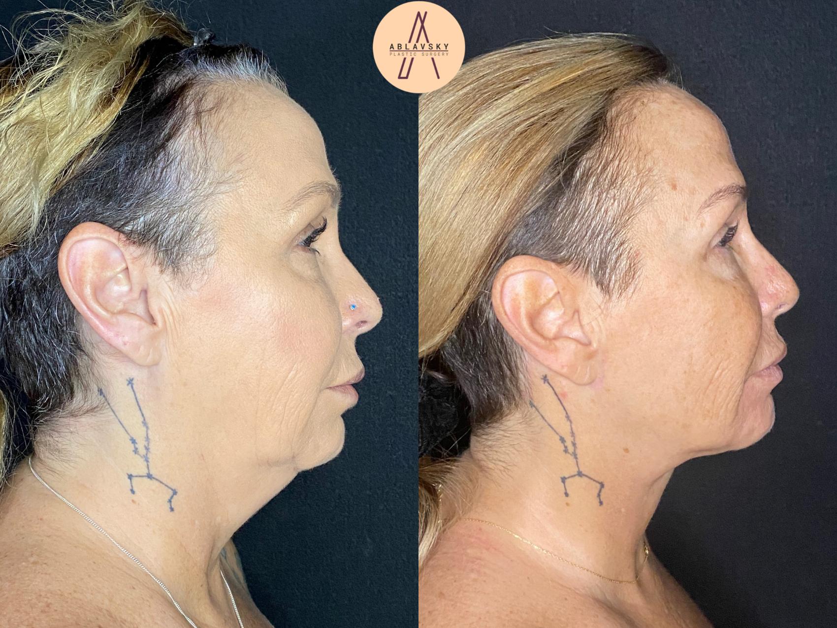Before & After Facelift & Neck Lift Case 45 Right Side View in San Antonio, Texas