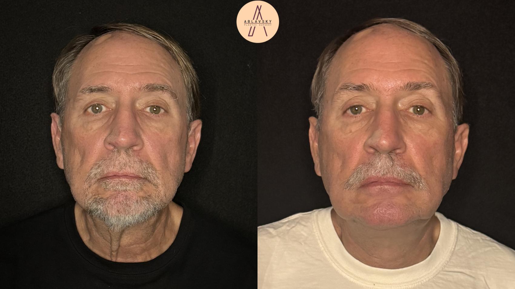 Before & After Facelift & Neck Lift Case 490 Front View in San Antonio, Texas