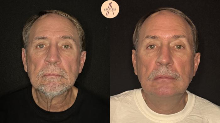 Before & After Facelift & Neck Lift Case 490 Front View in San Antonio, Texas