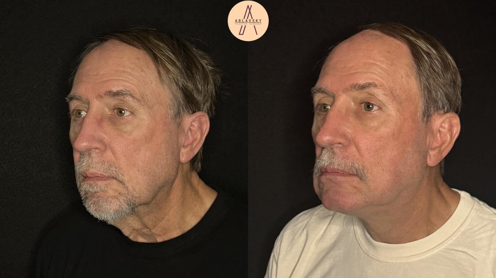 Before & After Facelift & Neck Lift Case 490 Left Oblique View in San Antonio, Texas