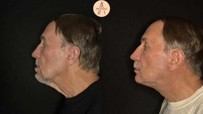 Before & After Facelift & Neck Lift Case 490 Left Side View in San Antonio, Texas