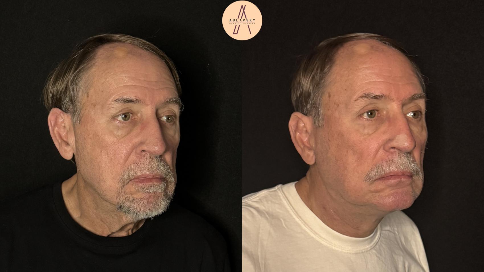 Before & After Facelift & Neck Lift Case 490 Right Oblique View in San Antonio, Texas