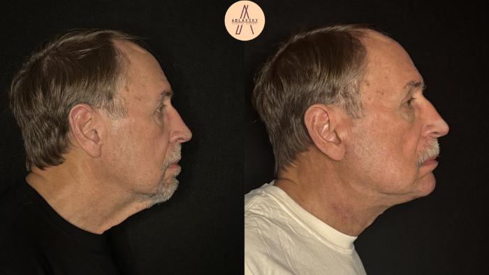 Before & After Facelift & Neck Lift Case 490 Right Side View in San Antonio, Texas