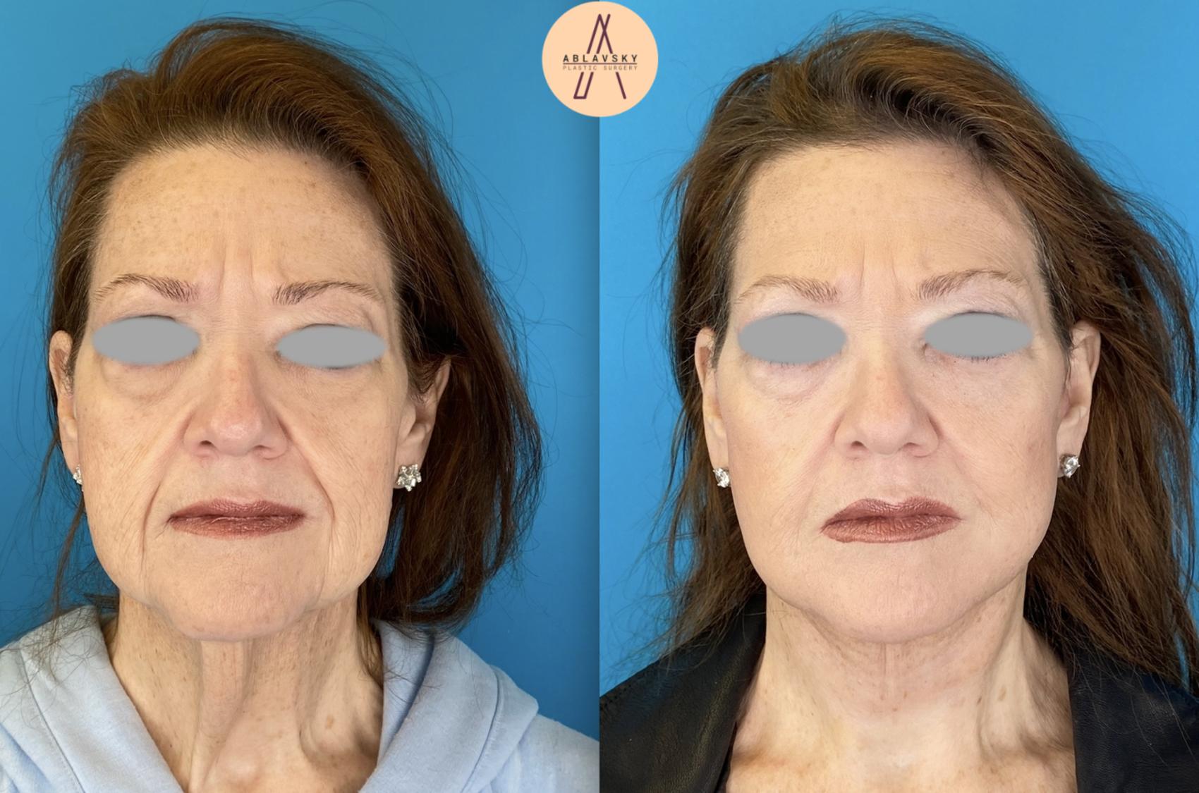 Before & After Facial Fat Grafting Case 5 Front View in San Antonio, Texas