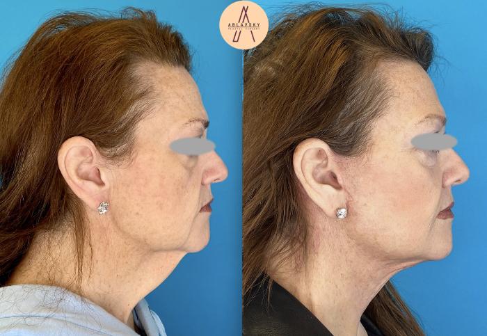 Before & After Facial Fat Grafting Case 5 Right Side View in San Antonio, Texas