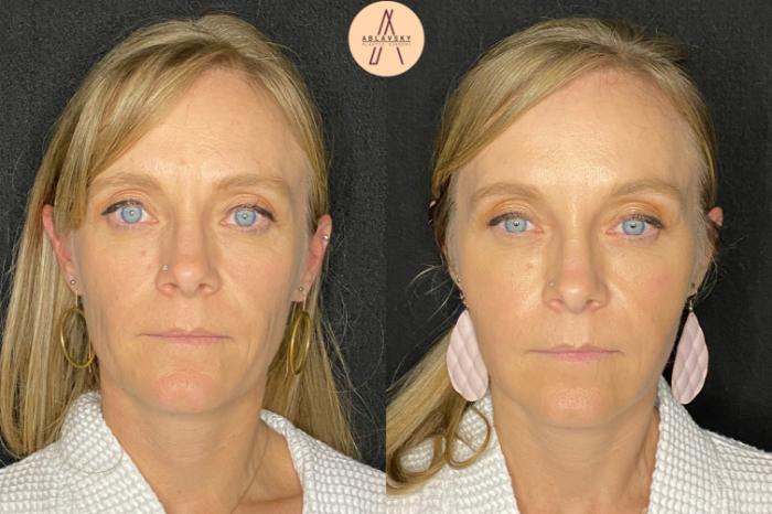 Before & After Facial Fat Grafting Case 51 Front View in San Antonio, Texas