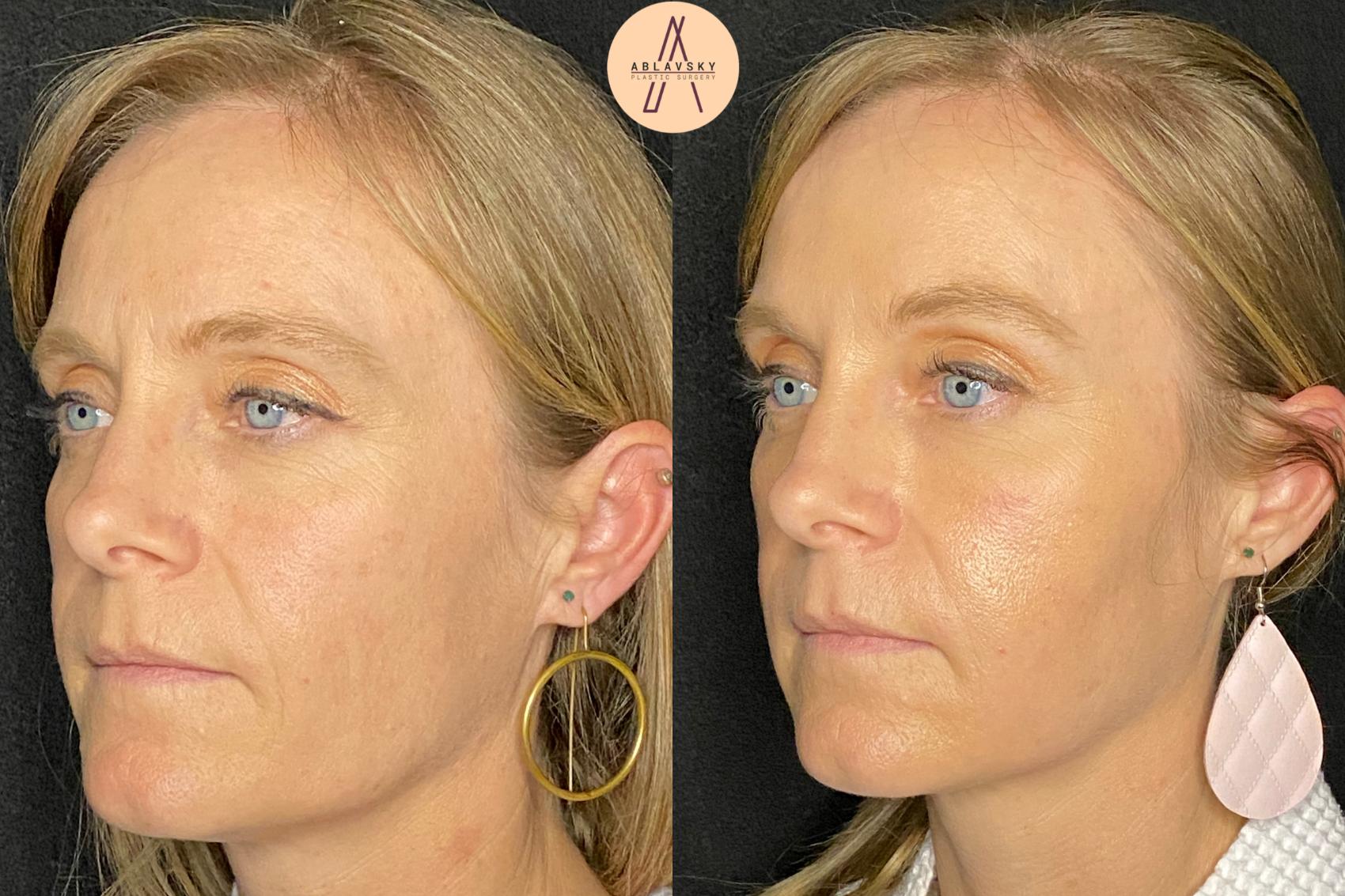 Before & After Facial Fat Grafting Case 51 Left Oblique View in San Antonio, Texas